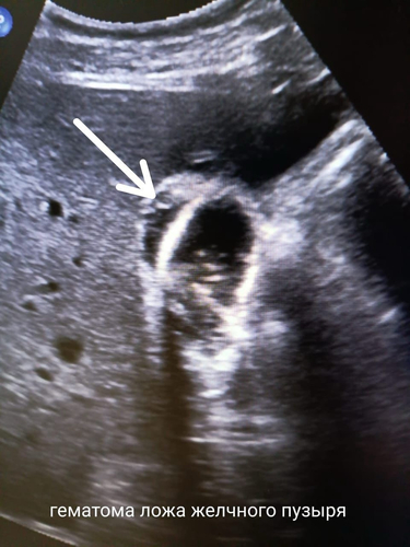 В городской клинической больнице скорой медицинской помощи провели нехирургическое лечение частичного отрыва желчного пузыря